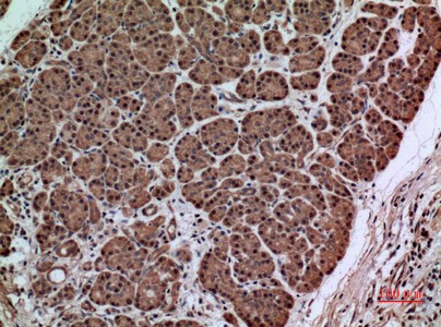  Immunohistochemical analysis of paraffin-embedded human-pancreas-cancer, antibody was diluted at 1:100