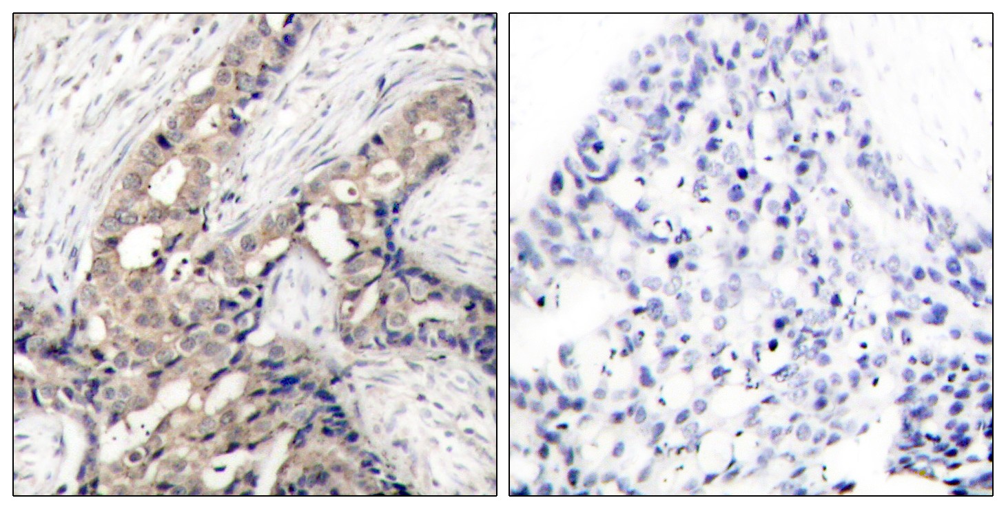  Immunohistochemistry analysis of paraffin-embedded human breast carcinoma, using Abl (Phospho-Tyr393/412) Antibody. The picture on the right is blocked with the phospho peptide.
