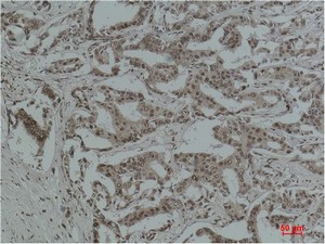  Immunohistochemical analysis of paraffin-embedded Human Breast Carcinoma using Acetyl Lysine Monoclonal Antibody.
