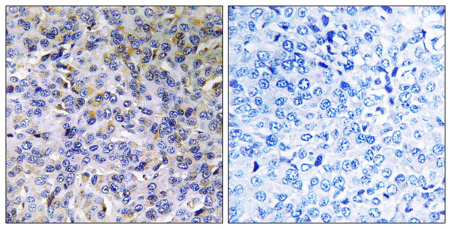  Immunohistochemistryt analysis of paraffin-embedded human breast carcinoma, using ACAD11 Antibody. The lane on the right is blocked with the ACAD11 peptide.