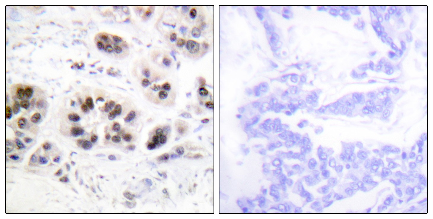  Immunohistochemistry analysis of paraffin-embedded human breast carcinoma tissue, using Histone H2A (Acetyl-Lys5) Antibody. The picture on the right is blocked with the synthesized peptide.