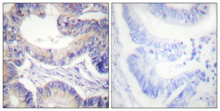  Immunohistochemical analysis of paraffin-embedded Human colon cancer. Antibody was diluted at 1:100(4°,overnight). High-pressure and temperature Tris-EDTA,pH8.0 was used for antigen retrieval. Negetive contrl (right) obtaned from antibody was pre-absorbed by immunogen peptide.