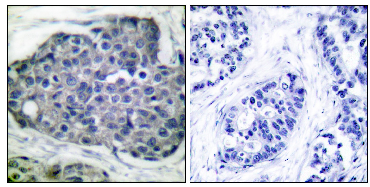  Immunohistochemistry analysis of paraffin-embedded human breast carcinoma, using Acetyl-CoA Carboxylase (Phospho-Ser80) Antibody. The picture on the right is blocked with the phospho peptide.