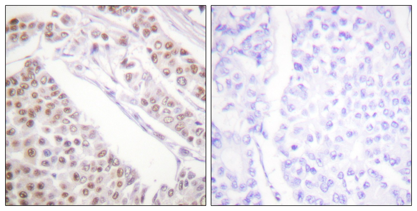  Immunohistochemistry analysis of paraffin-embedded human lung carcinoma tissue, using Histone H2B (Acetyl-Lys12) Antibody. The picture on the right is blocked with the synthesized peptide.