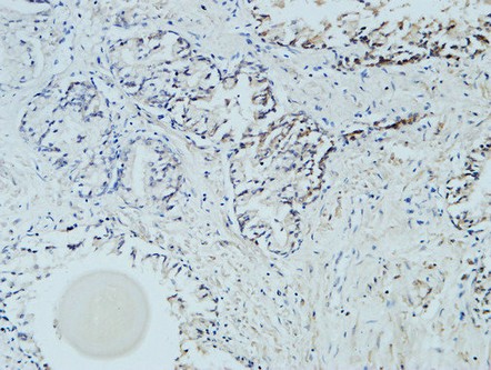  Immunohistochemical analysis of paraffin-embedded Human Prostate. 1, Antibody was diluted at 1:100(4°,overnight). 2, High-pressure and temperature EDTA, pH8.0 was used for antigen retrieval. 3,Secondary antibody was diluted at 1:200(room temperature, 30min).