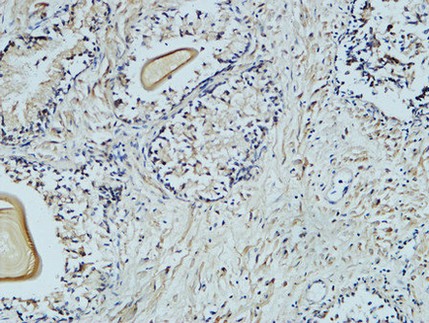  Immunohistochemical analysis of paraffin-embedded Human Prostate. 1, Antibody was diluted at 1:100(4°,overnight). 2, High-pressure and temperature EDTA, pH8.0 was used for antigen retrieval. 3,Secondary antibody was diluted at 1:200(room temperature, 30min).