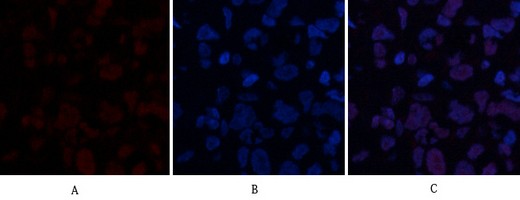  Immunofluorescence analysis of human-breast-cancer tissue. 1,ABCG2 Polyclonal Antibody(red) was diluted at 1:200(4°C,overnight). 2, Cy3 labled Secondary antibody was diluted at 1:300(room temperature, 50min).3, Picture B: DAPI(blue) 10min. Picture A:Target. Picture B: DAPI. Picture C: merge of A+B