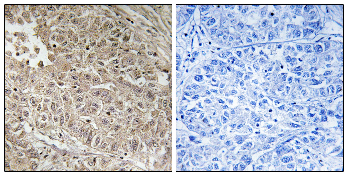  Immunohistochemistry analysis of paraffin-embedded human liver carcinoma tissue, using ABCC13 Antibody. The picture on the right is blocked with the synthesized peptide.