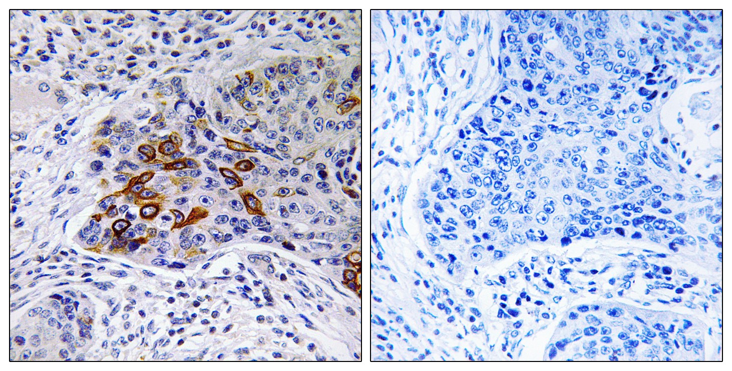  Immunohistochemistryt analysis of paraffin-embedded human lung carcinoma, using ADCY9 Antibody. The lane on the right is blocked with the ADCY9 peptide.