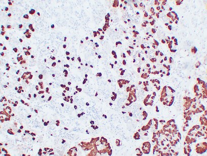  Immunohistochemical analysis of paraffin-embedded Pituitary adenoma. 1, Antibody was diluted at 1:200(4°,overnight). 2, Tris-EDTA,pH8.0 was used for antigen retrieval. 3,Secondary antibody was diluted at 1:200(room temperature, 30min).