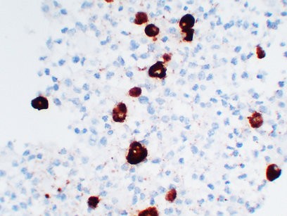 Immunohistochemical analysis of paraffin-embedded Pituitary adenoma. 1, Antibody was diluted at 1:200(4°,overnight). 2, Tris-EDTA,pH8.0 was used for antigen retrieval. 3,Secondary antibody was diluted at 1:200(room temperature, 30min).