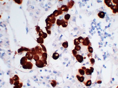 Immunohistochemical analysis of paraffin-embedded Pituitary adenoma. 1, Antibody was diluted at 1:200(4°,overnight). 2, Tris-EDTA,pH8.0 was used for antigen retrieval. 3,Secondary antibody was diluted at 1:200(room temperature, 30min).