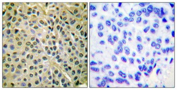  Immunohistochemical analysis of paraffin-embedded Human breast cancer. Antibody was diluted at 1:100(4°,overnight). High-pressure and temperature Tris-EDTA,pH8.0 was used for antigen retrieval. Negetive contrl (right) obtaned from antibody was pre-absorbed by immunogen peptide.