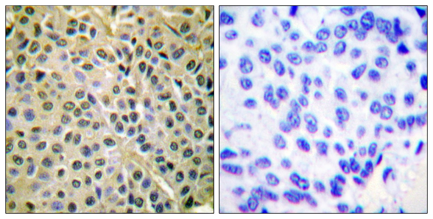  Immunohistochemistry analysis of paraffin-embedded human breast cancer, using Akt (Phospho-Ser473) Antibody. The picture on the right is blocked with the Akt (Phospho-Ser473) peptide.
