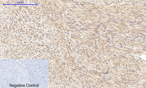  Immunohistochemical analysis of paraffin-embedded Human-uterus-cancer tissue. 1,Akt (phospho Thr308) Polyclonal Antibody was diluted at 1:200(4°C,overnight). 2, Sodium citrate pH 6.0 was used for antibody retrieval(>98°C,20min). 3,Secondary antibody was diluted at 1:200(room tempeRature, 30min). Negative control was used by secondary antibody only.