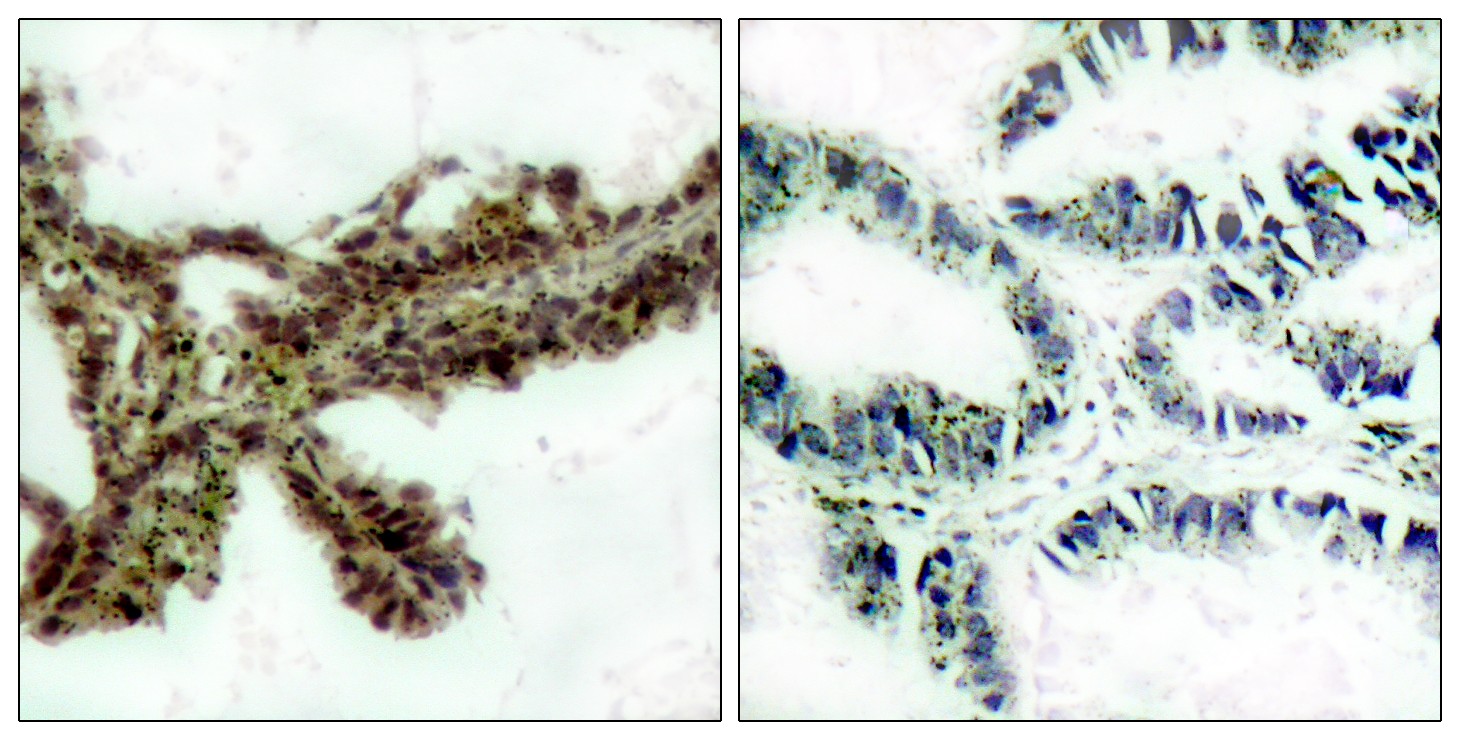  Immunohistochemistry analysis of paraffin-embedded human lung carcinoma, using Akt (Phospho-Thr308) Antibody. The picture on the right is blocked with the phospho peptide.
