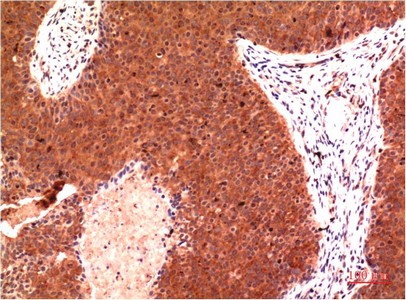  Immunohistochemical analysis of paraffin-embedded Human Colon Carcinoma Tissue using Gamma Tubulin Mouse mAb diluted at 1:200.