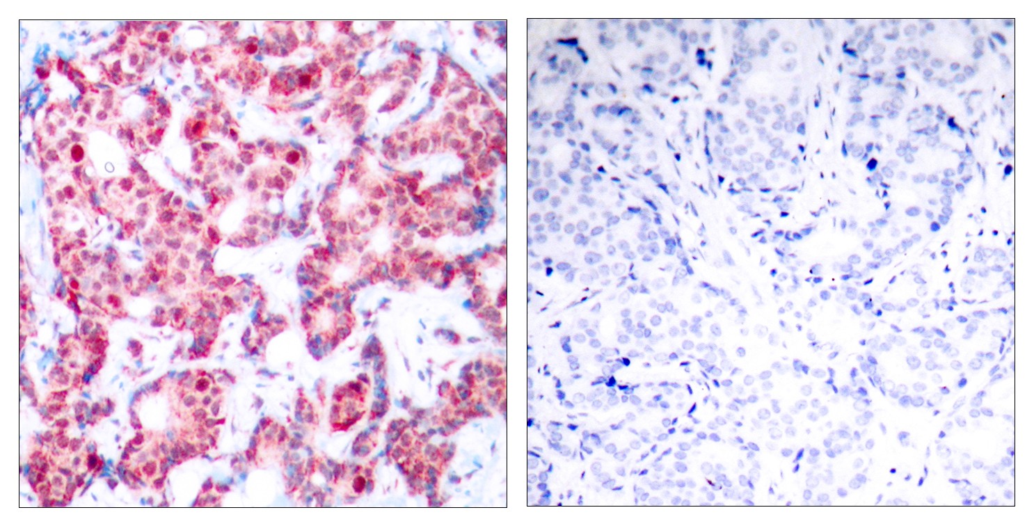  Immunohistochemistry analysis of paraffin-embedded human breast carcinoma, using GATA1 (Phospho-Ser142) Antibody. The picture on the right is blocked with the phospho peptide.