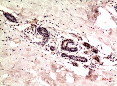  Immunohistochemical analysis of paraffin-embedded Human Breast Carcinoma Tissue using gamma Tutulin Mouse mAb diluted at 1:200.