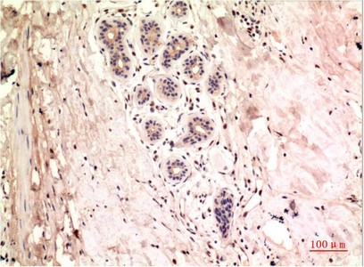  Immunohistochemical analysis of paraffin-embedded Human Breast Carcinoma Tissue using gamma Tutulin Mouse mAb diluted at 1:200.