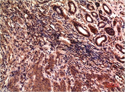  Immunohistochemical analysis of paraffin-embedded Human Breast Carcinoma Tissue using Gamma Tubulin Mouse mAb diluted at 1:200.