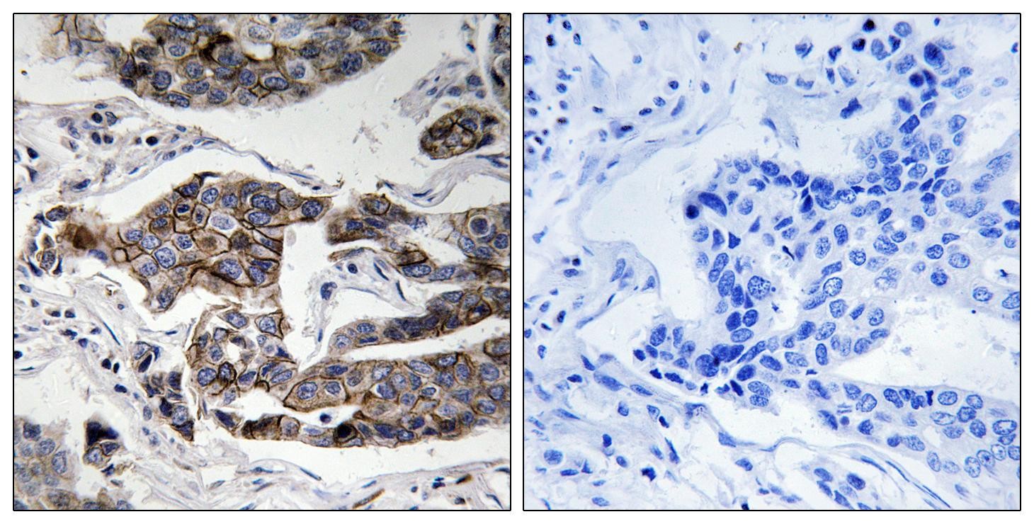  Immunohistochemistry analysis of paraffin-embedded human breast carcinoma, using Girdin (Phospho-Ser1417) Antibody. The picture on the right is blocked with the phospho peptide.
