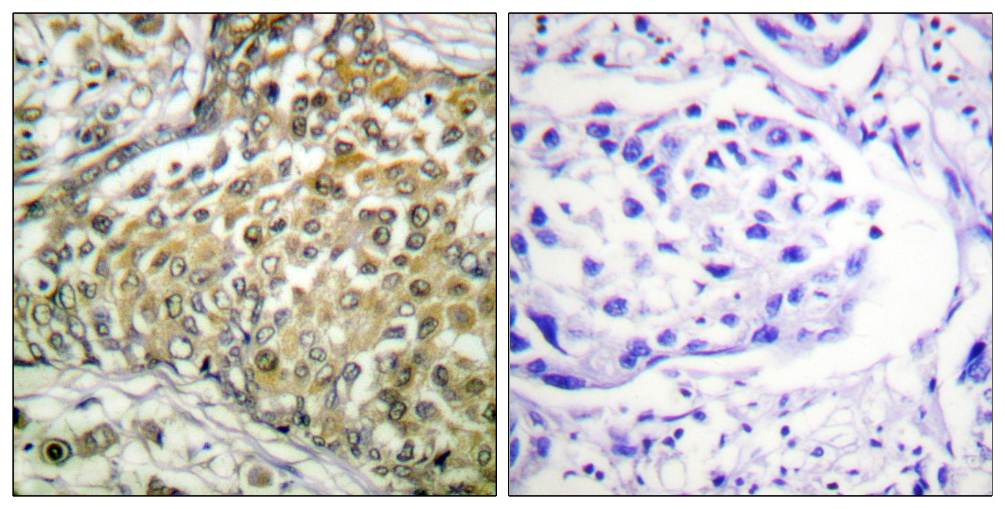  Immunohistochemistry analysis of paraffin-embedded human lung carcinoma tissue, using p53 (Acetyl-Lys379) Antibody. The picture on the right is blocked with the synthesized peptide.