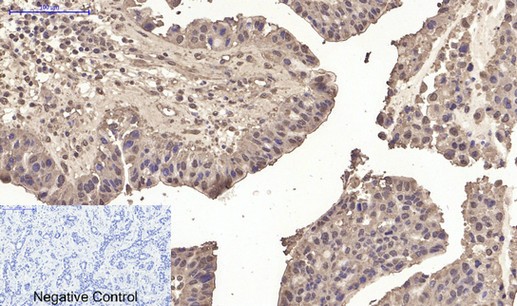  Immunohistochemical analysis of paraffin-embedded Human-liver-cancer tissue. 1,p53 (Di Methyl Lys370) Polyclonal Antibody was diluted at 1:200(4°C,overnight). 2, Sodium citrate pH 6.0 was used for antibody retrieval(>98°C,20min). 3,Secondary antibody was diluted at 1:200(room tempeRature, 30min). Negative control was used by secondary antibody only.