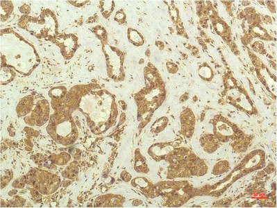  Immunohistochemical analysis of paraffin-embedded Human Breast Carcinoma Tissue using P70 S6 Kinase Mouse mAb diluted at 1:200.