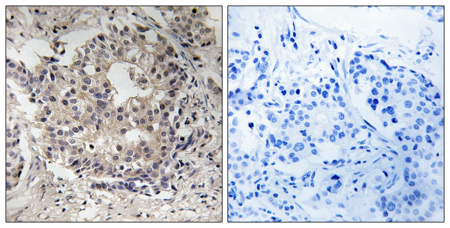  Immunohistochemistry analysis of paraffin-embedded human breast cancer, using S6 Ribosomal Protein (Phospho-Ser235+Ser236) Antibody. The picture on the right is blocked with the S6 Ribosomal Protein (Phospho-Ser235+Ser236) peptide.