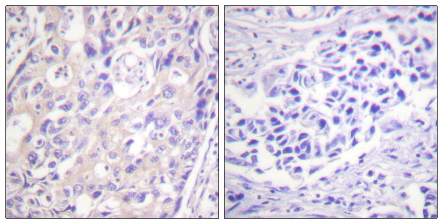  Immunohistochemistry analysis of paraffin-embedded human breast carcinoma, using p90 RSK (Phospho-Thr359+Ser363) Antibody. The picture on the right is blocked with the phospho peptide.