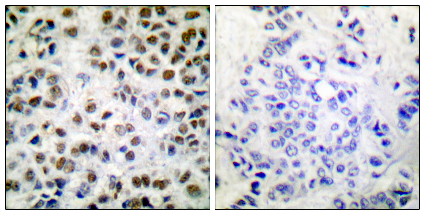  Immunohistochemistry analysis of paraffin-embedded human breast carcinoma, using POLR2A (Phospho-Ser1619) Antibody. The picture on the right is blocked with the phospho peptide.