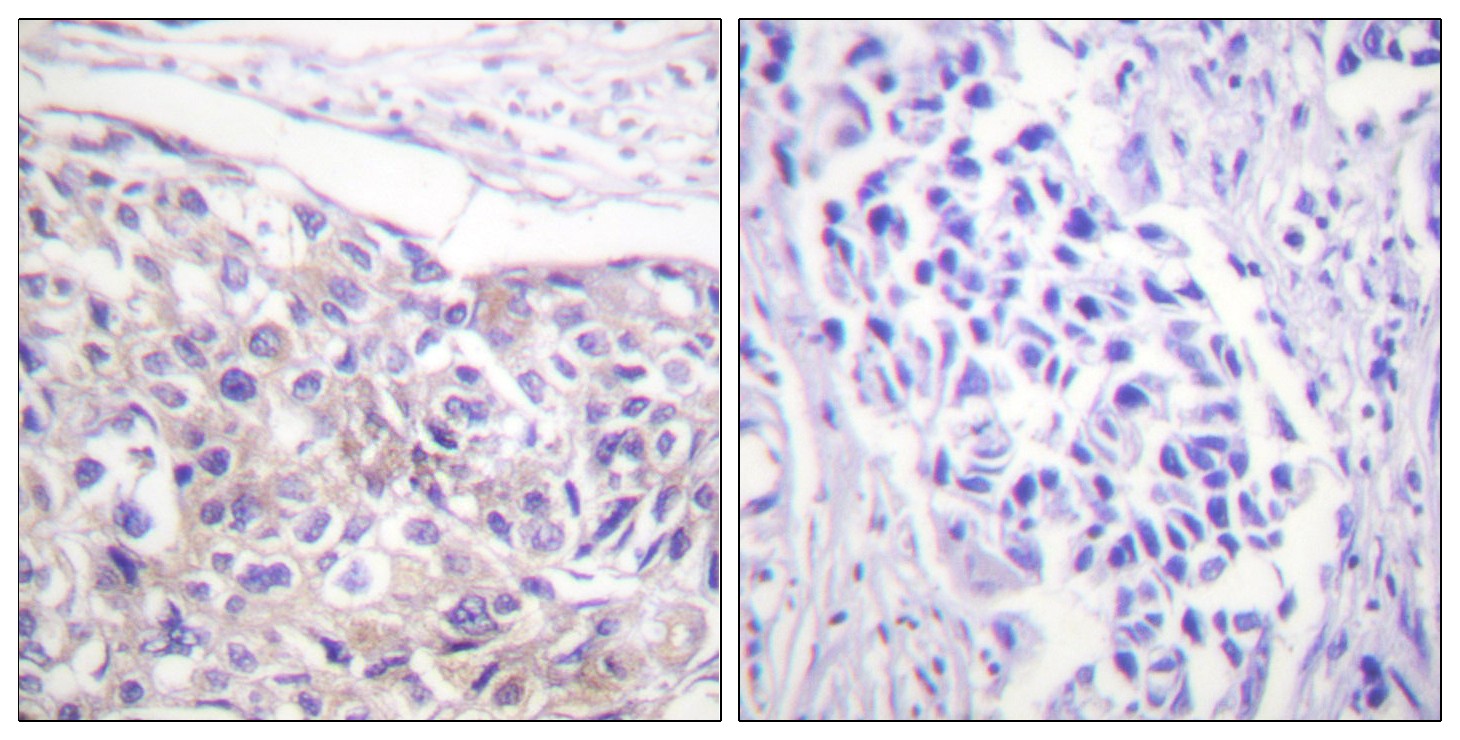  Immunohistochemistry analysis of paraffin-embedded human breast carcinoma, using p90 RSK (Phospho-Thr573) Antibody. The picture on the right is blocked with the phospho peptide.