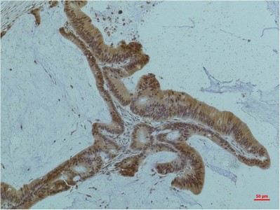  Immunohistochemical analysis of paraffin-embedded Human Live rTissue using Smad3(mAb diluted at 1:200.
