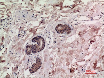  Immunohistochemical analysis of paraffin-embedded Human Breast Carcinoma Tissue using Smad3 Mouse mAb diluted at 1:200.