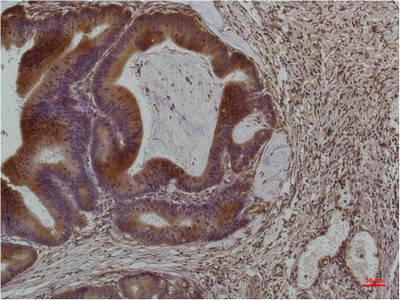  Immunohistochemical analysis of paraffin-embedded Human Colon Carcinoma using Smad3Mouse mAb diluted at 1:200.