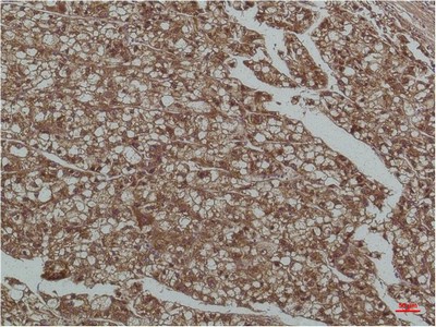  Immunohistochemical analysis of paraffin-embedded Human Liver Tissue using Smad3Mouse mAb diluted at 1:200.