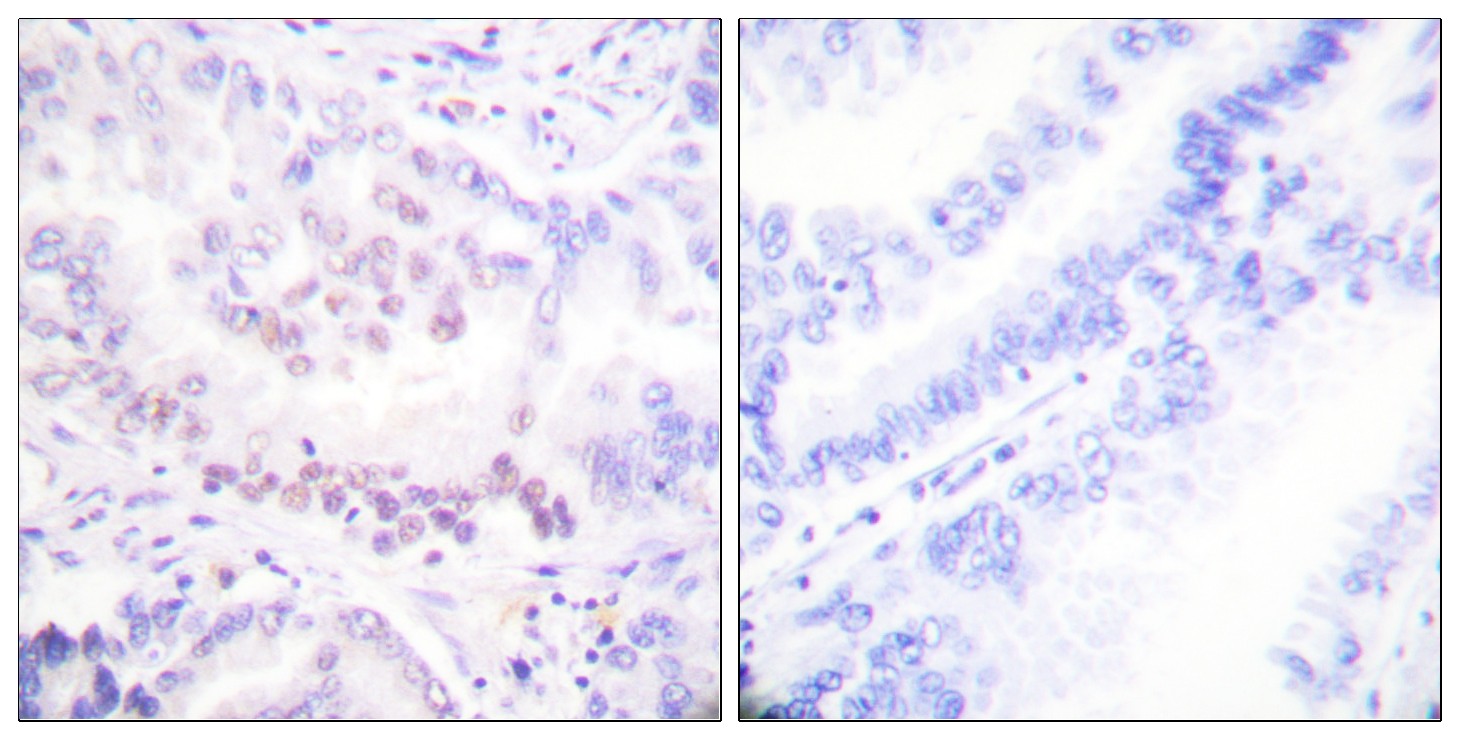  Immunohistochemistry analysis of paraffin-embedded human lung carcinoma, using AML1 (Phospho-Ser303) Antibody. The picture on the right is blocked with the phospho peptide.