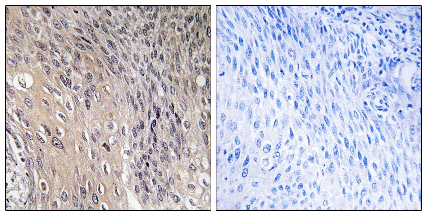 Immunohistochemistry analysis of paraffin-embedded human cervix carcinoma, using ARHGDIA (Phospho-Ser174) Antibody. The picture on the right is blocked with the phospho peptide.