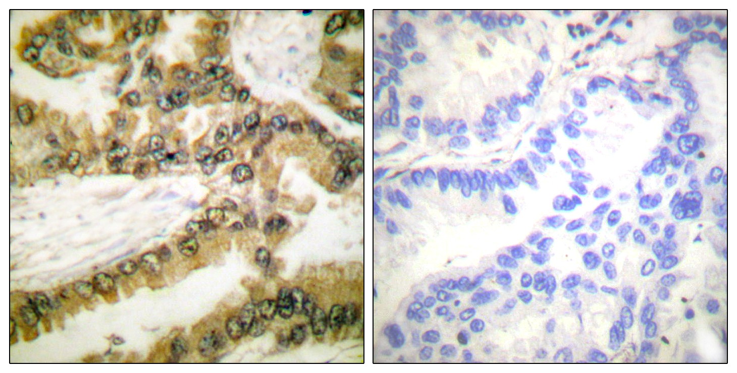  Immunohistochemistry analysis of paraffin-embedded human lung carcinoma, using Akt1 (Phospho-Thr450) Antibody. The picture on the right is blocked with the phospho peptide.