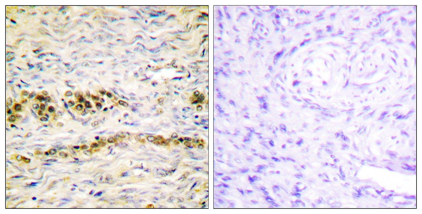  Immunohistochemistry analysis of paraffin-embedded human ovary, using Akt (Phospho-Tyr474) Antibody. The picture on the right is blocked with the phospho peptide.