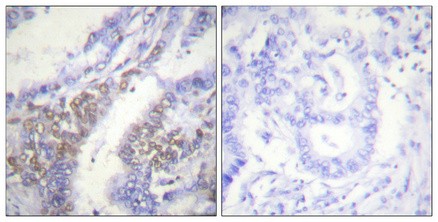  Immunohistochemical analysis of paraffin-embedded Human lung cancer. Antibody was diluted at 1:100(4°,overnight). High-pressure and temperature Tris-EDTA,pH8.0 was used for antigen retrieval. Negetive contrl (right) obtaned from antibody was pre-absorbed by immunogen peptide.