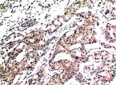  Immunohistochemical analysis of paraffin-embedded Human Breast Carcinoma Tissue using Ubiquitin Mouse mAb diluted at 1:200.