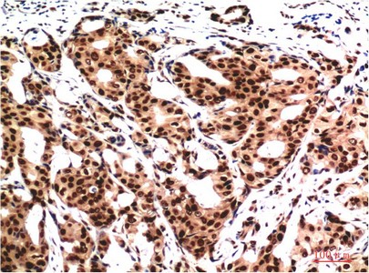  Immunohistochemical analysis of paraffin-embedded Human Breast CarcinomaTissue using Ubiquitin Mouse mAb diluted at 1:200.