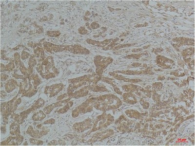  Immunohistochemical analysis of paraffin-embedded Human Breast Carcinoma using a-tubulin(Acetyl Lys40) Mouse mAb diluted at 1:200.