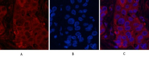  Immunofluorescence analysis of Human-liver-cancer tissue. 1,α-tubulin (Acetyl Lys40) Monoclonal Antibody(4A8)(red) was diluted at 1:200(4°C,overnight). 2, Cy3 labled Secondary antibody was diluted at 1:300(room temperature, 50min).3, Picture B: DAPI(blue) 10min. Picture A:Target. Picture B: DAPI. Picture C: merge of A+B